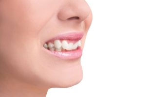 ارتودنسی دندان های پیش