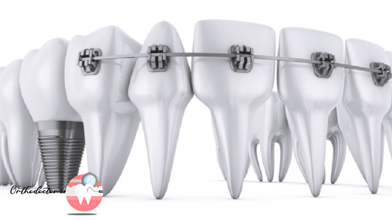 تراز کردن دندان پیش از قرار دادن ایمپلنت یا روکش دندان