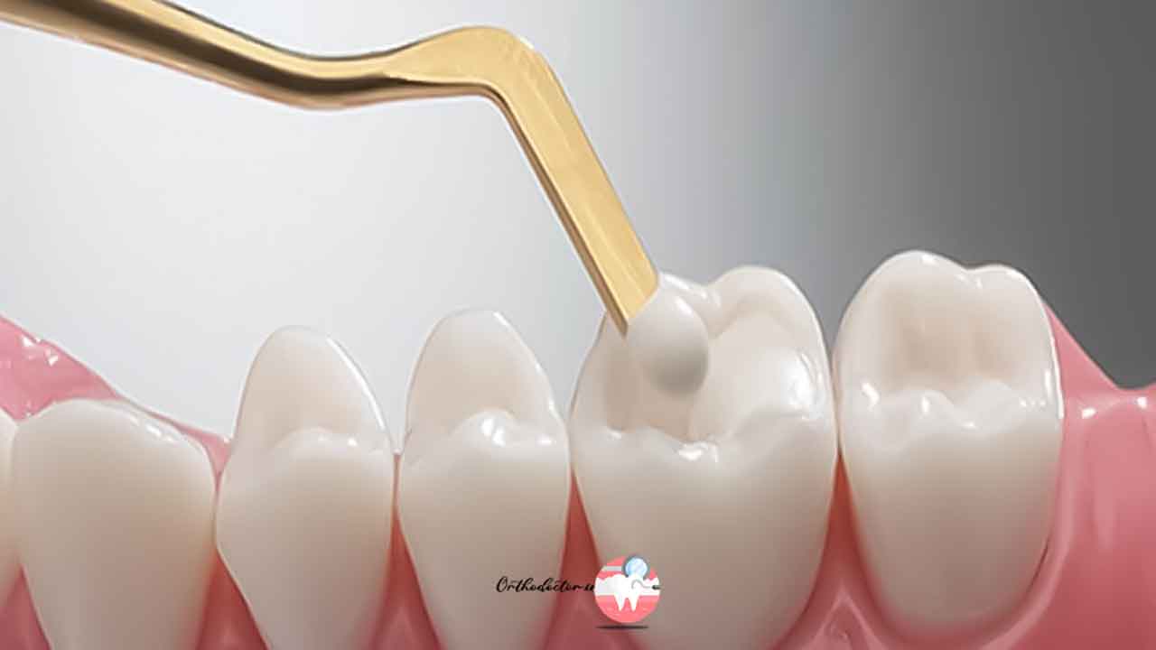 کامپوزیت دندان چیست؟