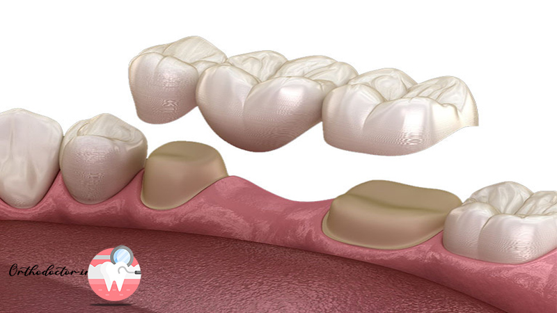 انواع بریج دندان
