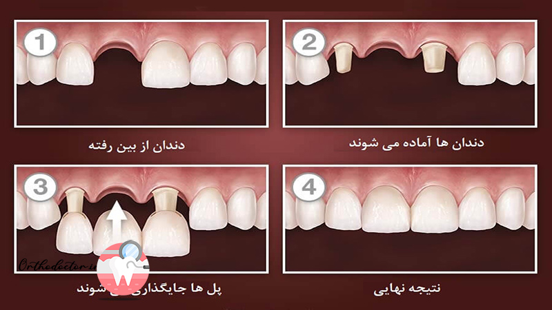 مراحل بریج دندان