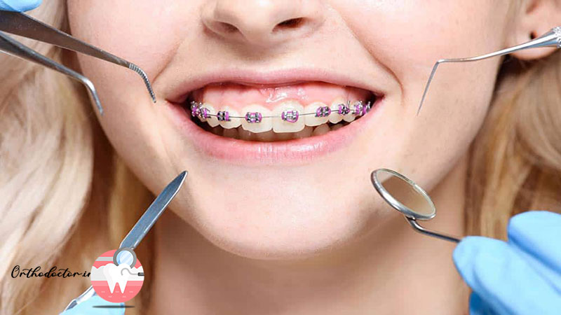 انواع ارتودنسی دندان