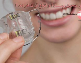 ارتودنسی متحرک