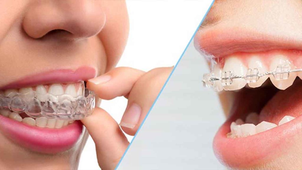 تفاوت ارتودنسی ثابت و متحرک