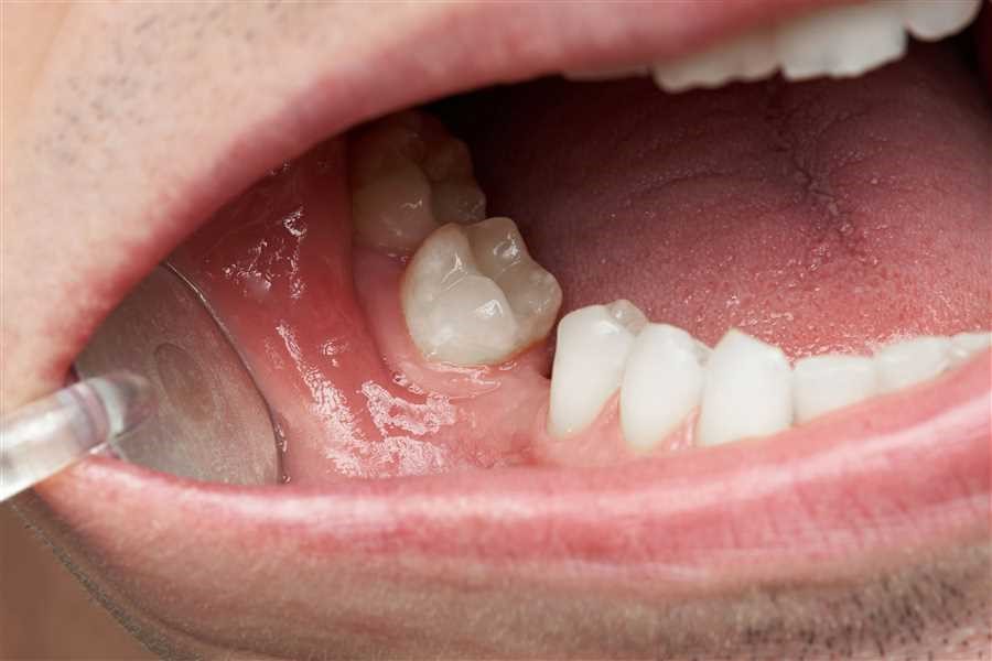  ارتودنسی دندان های پیش 