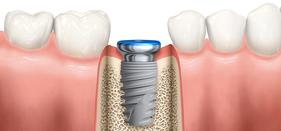روش انجام ایمپلنت دندان