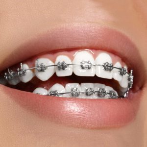 ارتودنسی با کشیدن دندان، ارتودنسی
