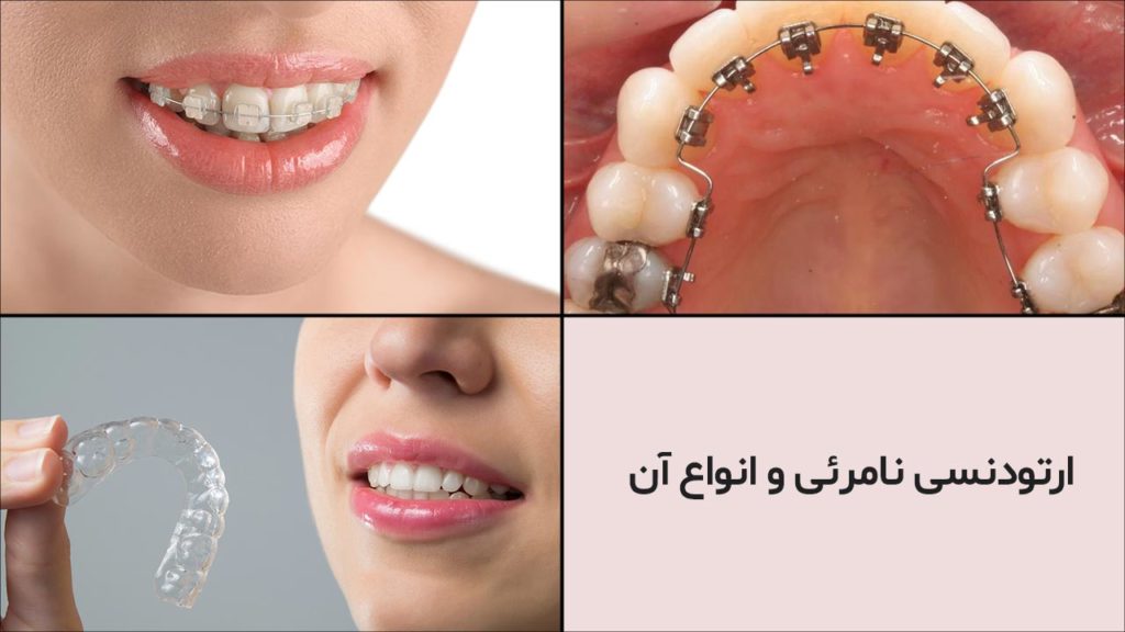 ارتودنسی-نامرئی