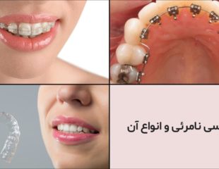 ارتودنسی-نامرئی