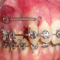 ارتودنسی عقب بردن دندان