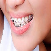 ارتودنسی 6 ماهه