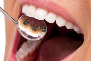  ارتودنسی پشت دندان