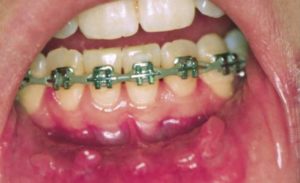ارتودنسی دندان چه عوارضی دارد 