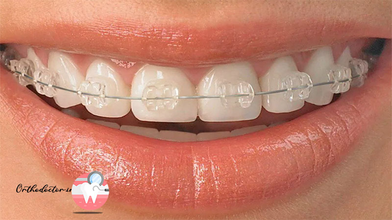 ارتودنسی سرامیکی