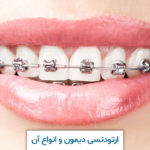 ارتودنسی دیمون و انواع آن