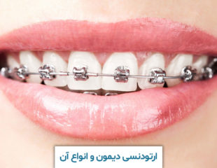 ارتودنسی دیمون و انواع آن