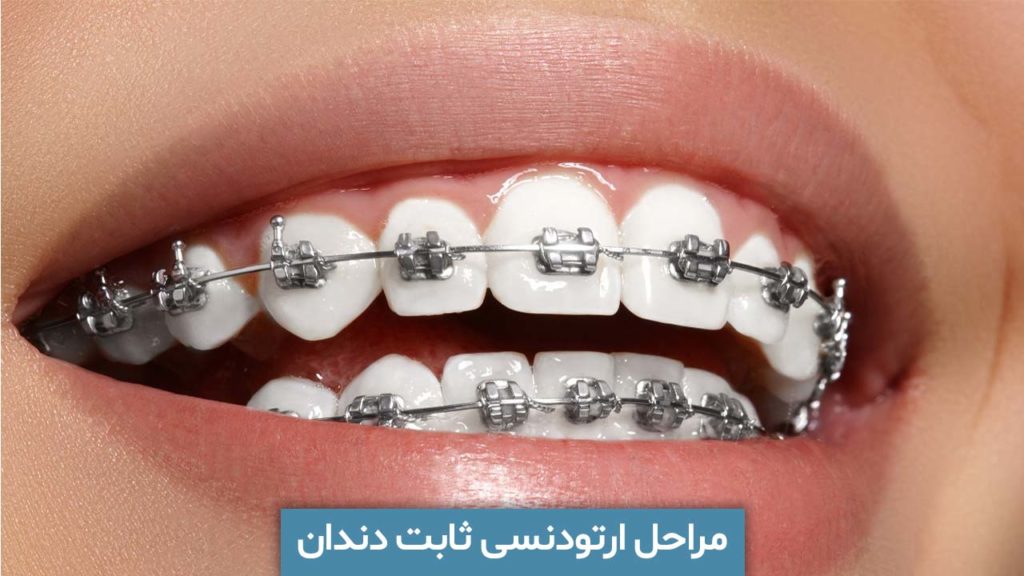 مراحل ارتودنسی ثابت دندان