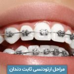 مراحل ارتودنسی ثابت دندان