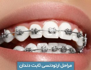 مراحل ارتودنسی ثابت دندان