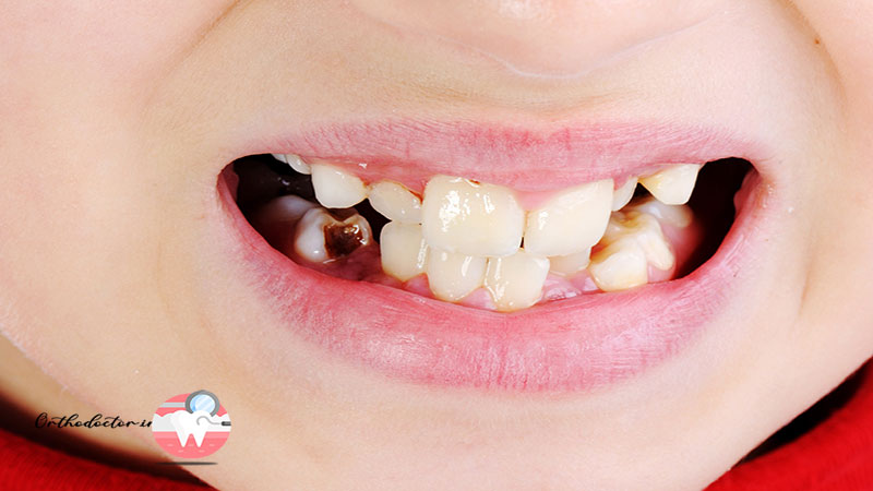 عوامل مؤثر بر کشیدن دندان در ارتودنسی