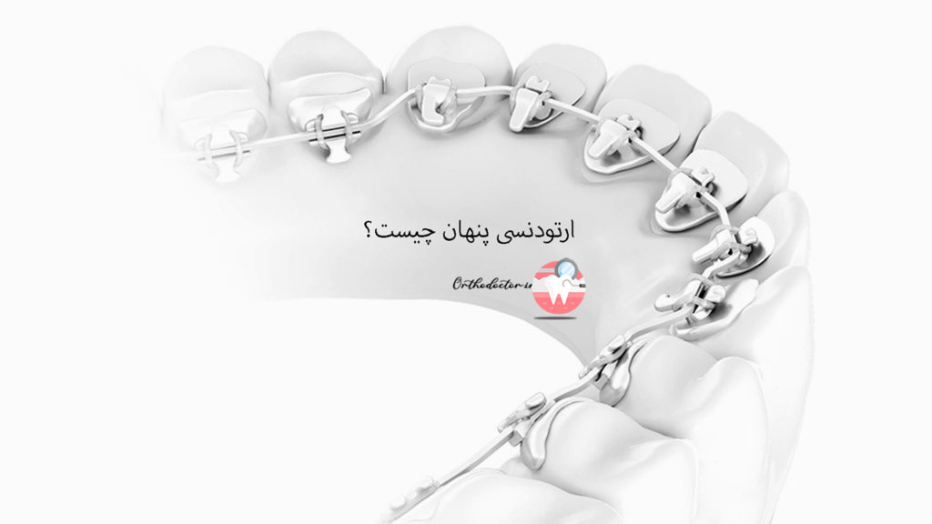ارتودنسی پنهان
