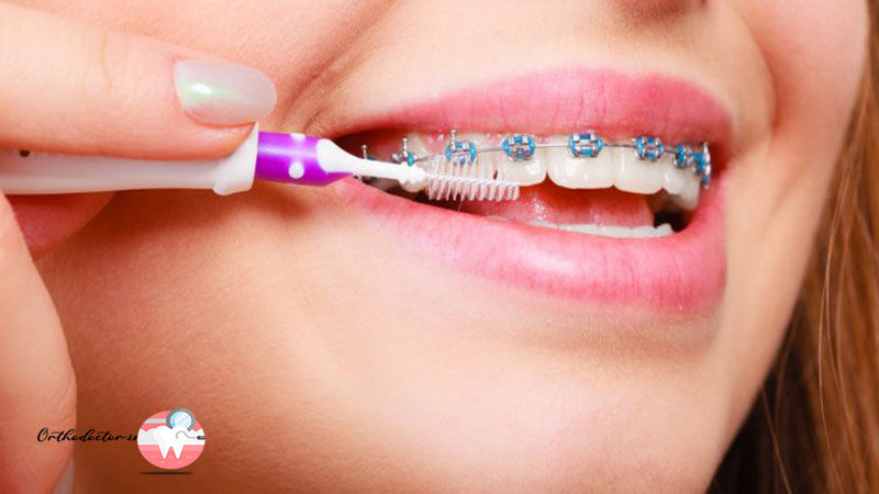 بهداشت دهان و دندان ارتودنسی
