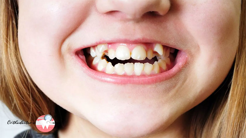 ناهنجاری دندان در کودکان