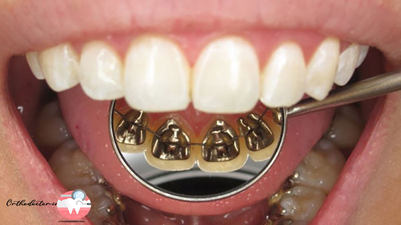  براکت پشت دندانی 