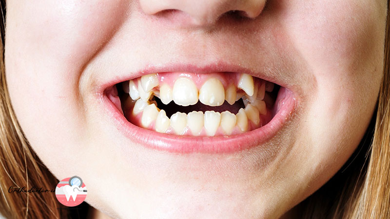 دندان اضافی چیست
