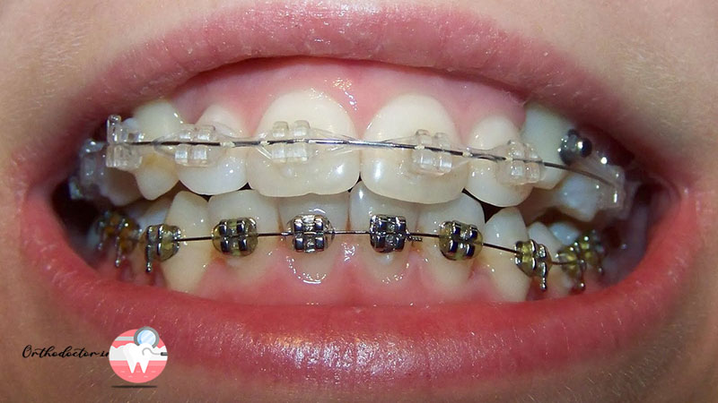 درمان دندان اضافی