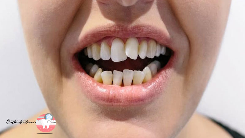 بروز فشردگی و نامرتبی دندان ها 