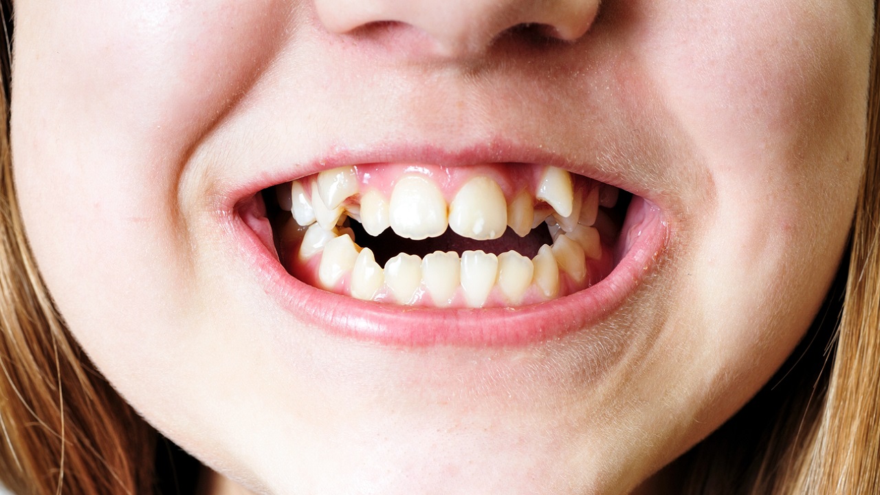 ارتودنسی دندان اضافی-دندان اضافی چیست؟