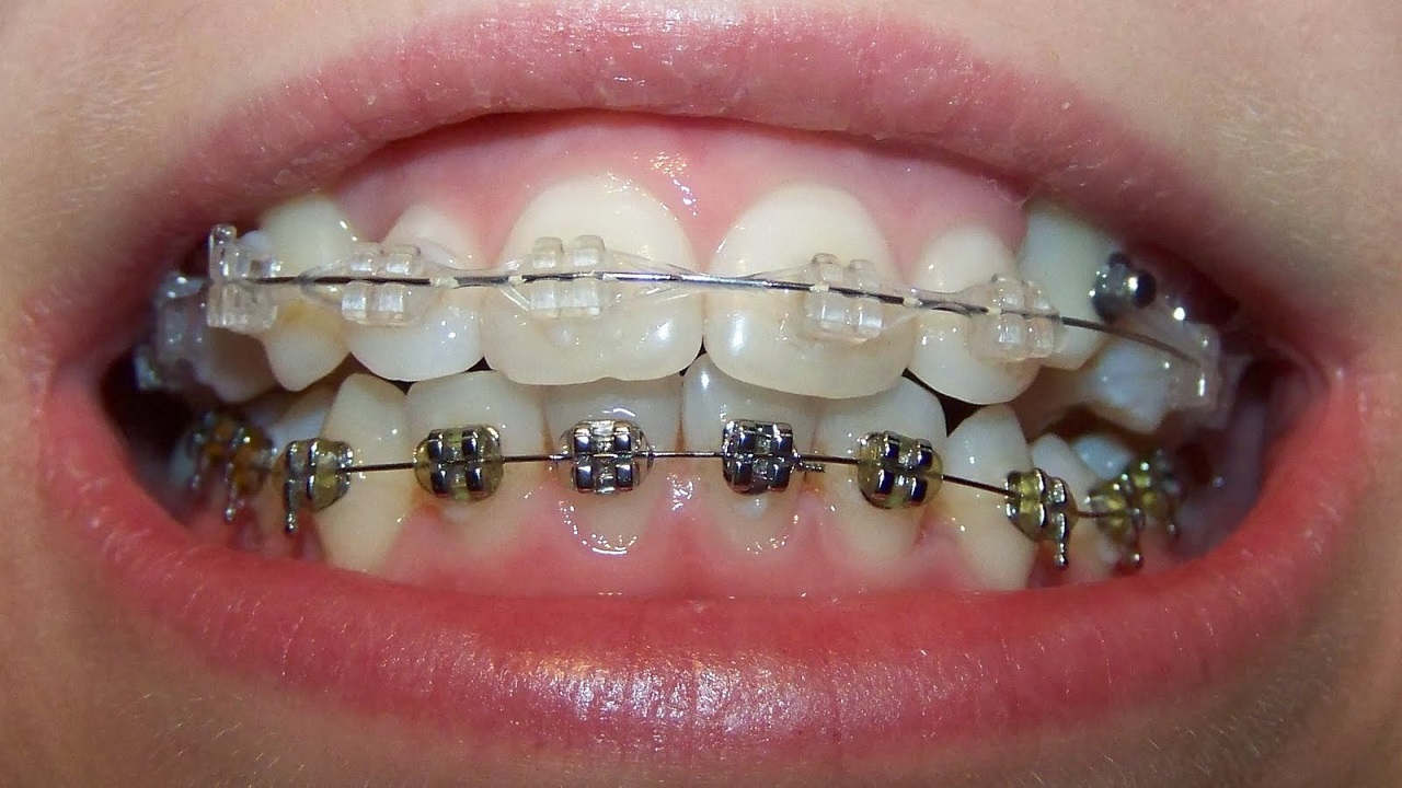 ارتودنسی دندان اضافی-کشیدن دندان اضافی در ارتودنسی