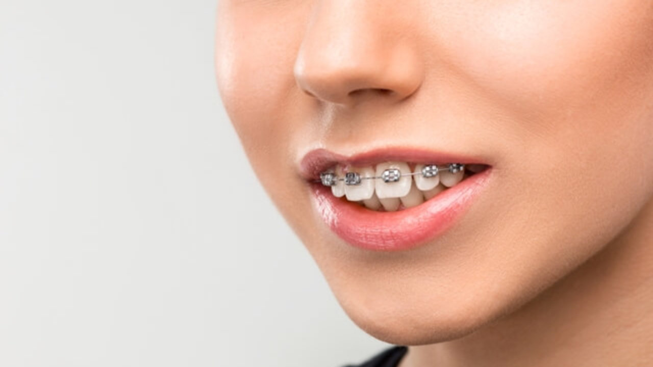 چه مدت باید از بریس استفاده کرد؟