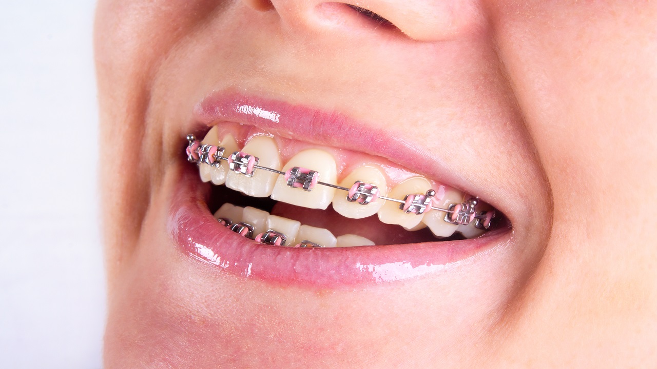 ارتودنسی یا لمینت-ارتودنسی دندان