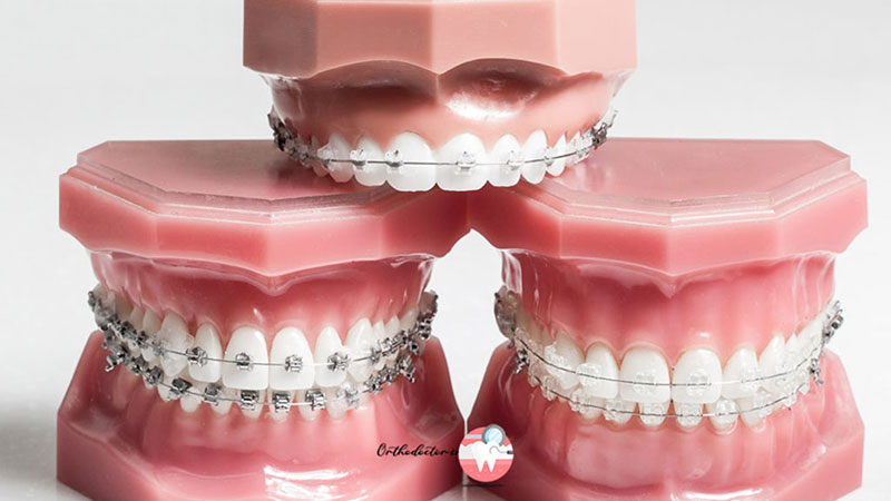 انواع درمان ارتودنسی دندان
