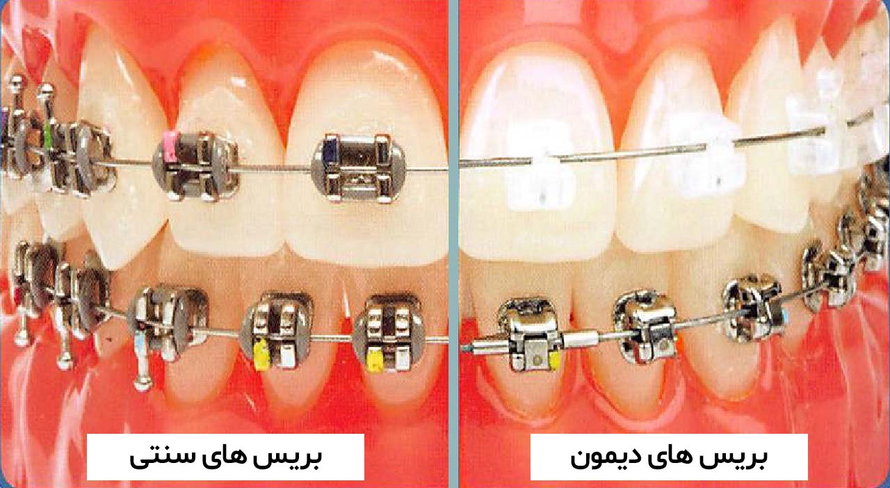 تفاوت ارتودنسی دیمون و سنتی
