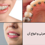 ارتودنسی نامرئی