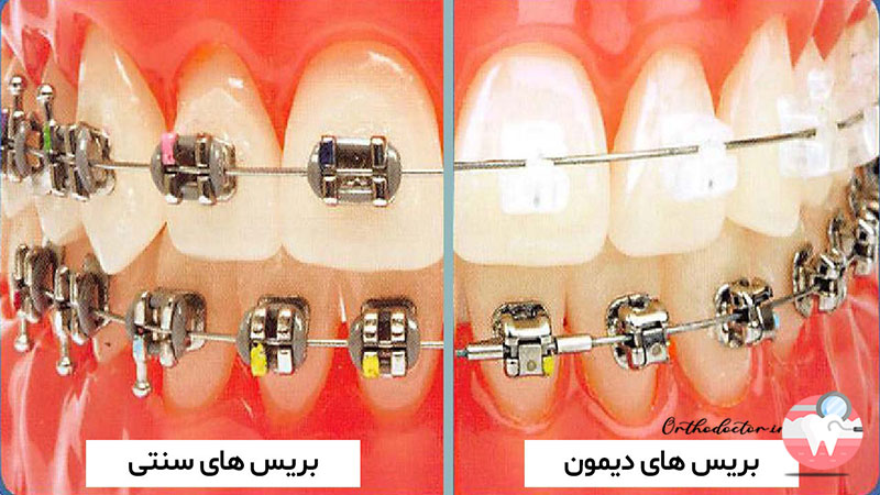 بریس های دیمون و سنتی