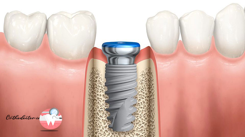 روش انجام ایمپلنت
