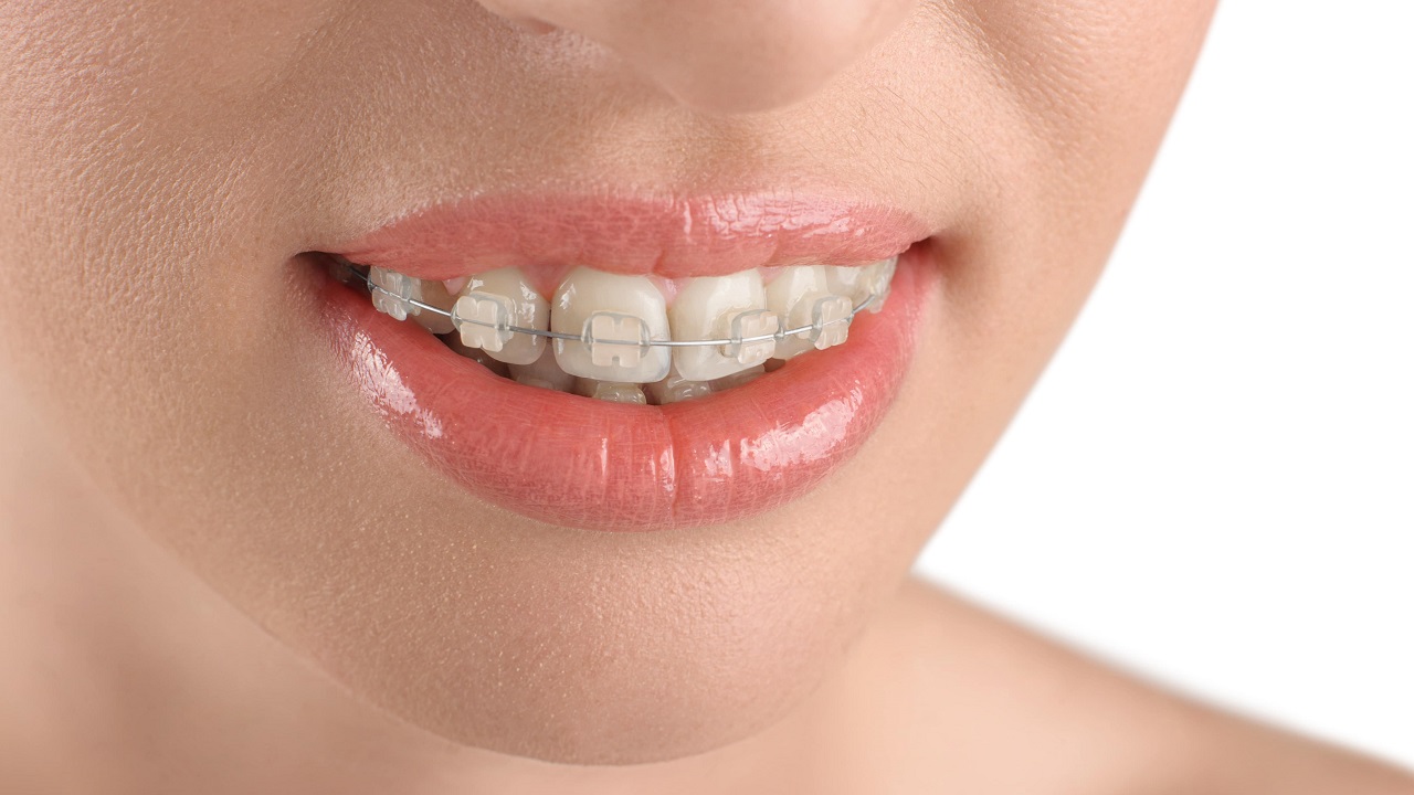 ارتودنسی سرامیکی دندان