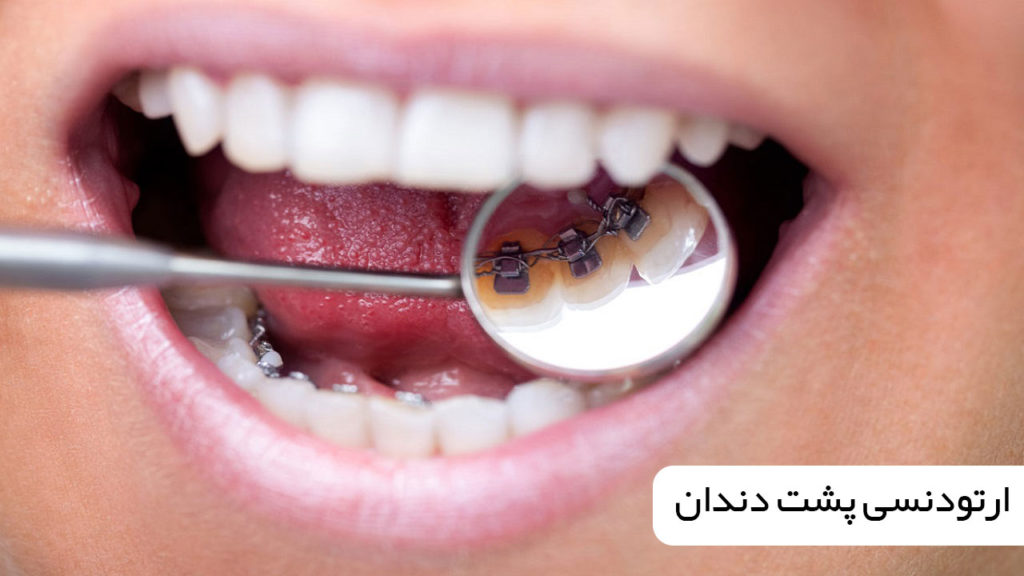 ارتودنسی پشت دندان