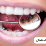 ارتودنسی پشت دندان