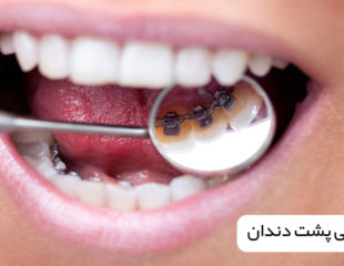 ارتودنسی پشت دندان