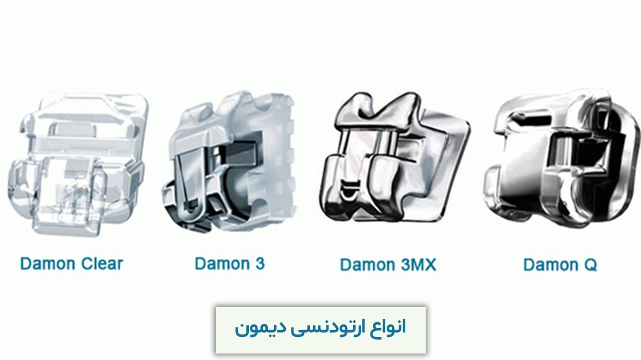 انواع ارتودنسی دیمون