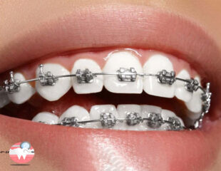مراحل ارتودنسی ثابت دندان