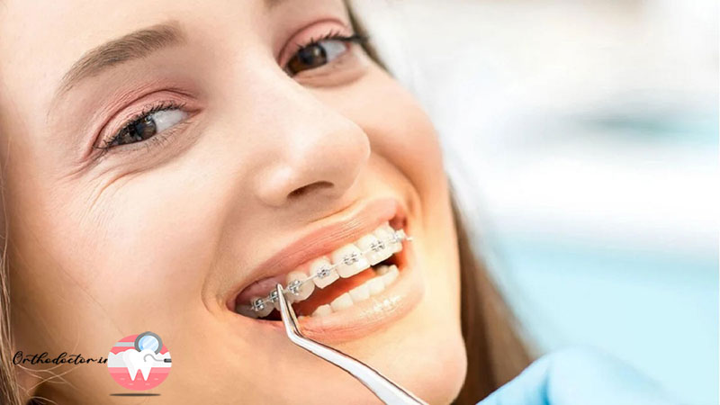ارتودنسی ثابت دندان
