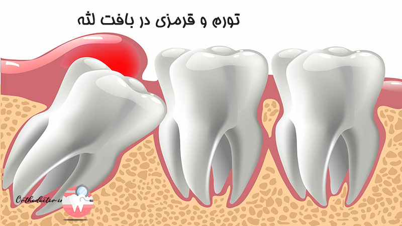 تورم و قرمزی در بافت لثه