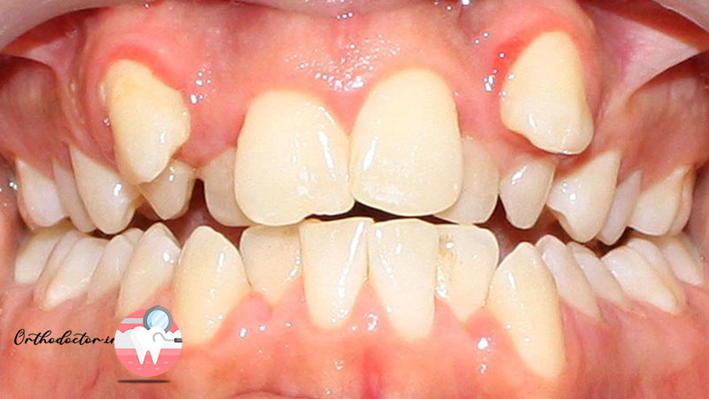 ارتودنسی دندان نیش
