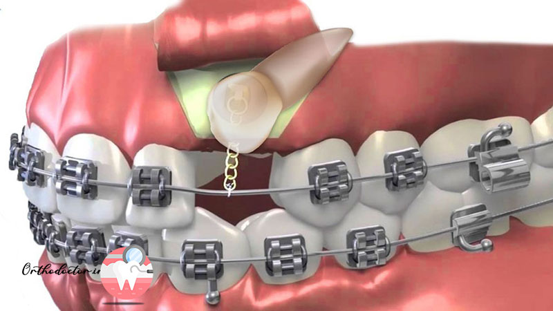 هزینه ارتودنسی یک دندان